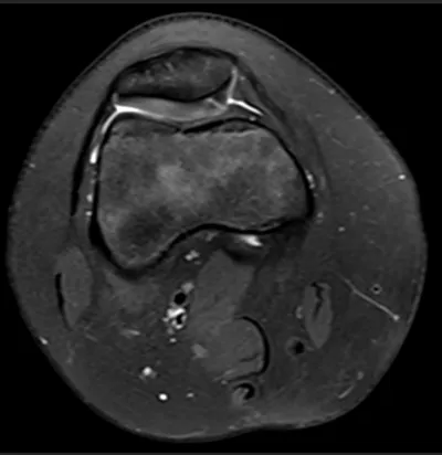 Cartilage fissure on medial patella