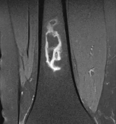 Bone infarct geographic appearance