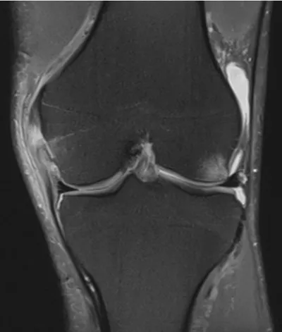 Medial Collateral Ligament (MCL) injury (grade 2)