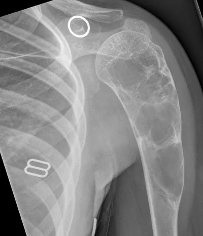 Aneurysmal bone cyst of proximal humerus
