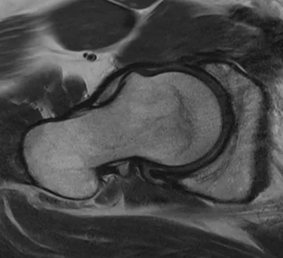 Cam morphology (extreme) of femoral neck (FAI)