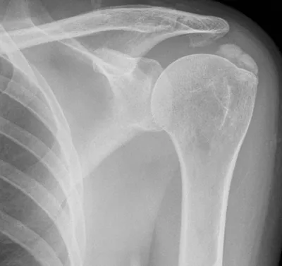 Calcific tendinopathy of supraspinatus