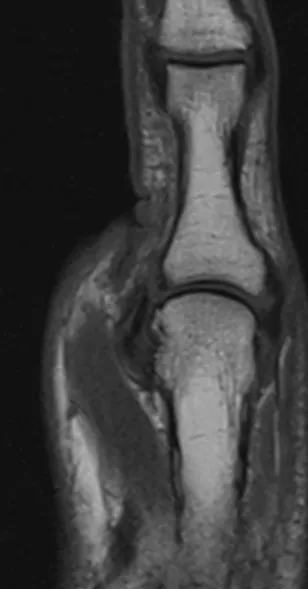 Stener Lesion - Ulnar Collateral ligament tear