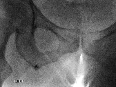 Common Hamstring Tendon Injection