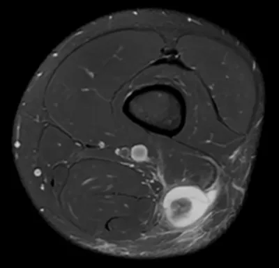 Torn long head of biceps femoris - BAMIC grade 4
