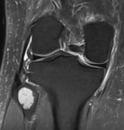 Enchondroma of fibula head