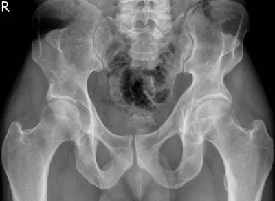 Fong's Prongs - Nail Patella Syndrome