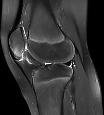 Inferior patellar apophyseal traction injury