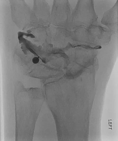 Mid-carpal row injection