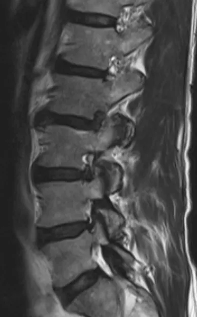 Foraminal disc herniation (filled keyhole sign)
