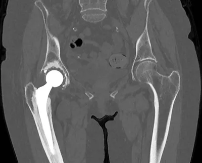 Hip arthroplasty as seen on CT scan