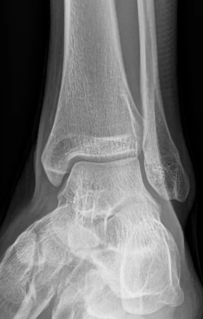 Mortise View of the Ankle