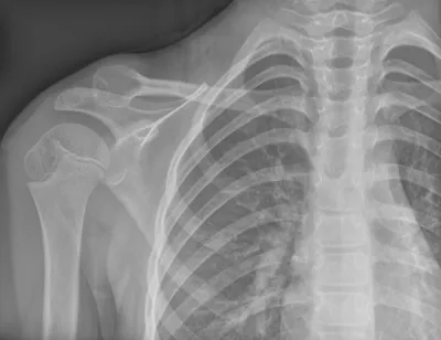 Aneurysmal Bone Cyst (ABC) of Clavicle