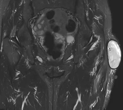 Morel Lavallée lesion over greater trochanter