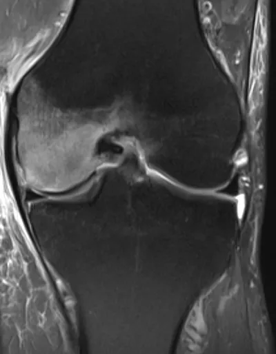 Subchondral Insufficiency Fracture
