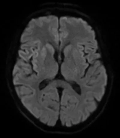 Prion Disease - Sporadic CJD