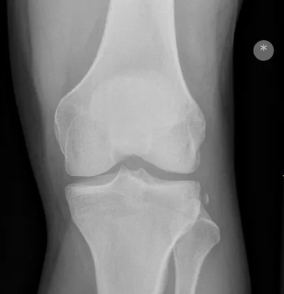 Segond fracture