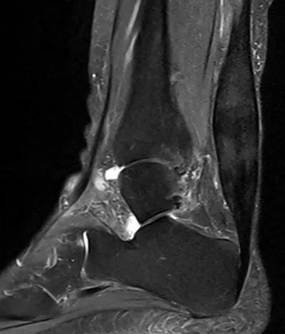 Severe mid-Achilles tendinopathy