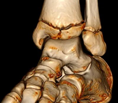 Tillaux fracture