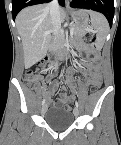 Mesenteric lymphadenitis