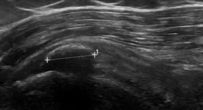 Calcific tendinopathy of supraspinatus