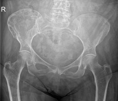 Paget's disease, right iliac wing