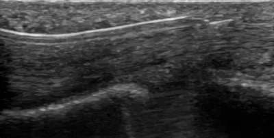 Ultrasound Guided Percutaneous A1 Pulley Release