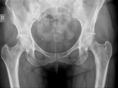Ossification of injured right acetabular labrum