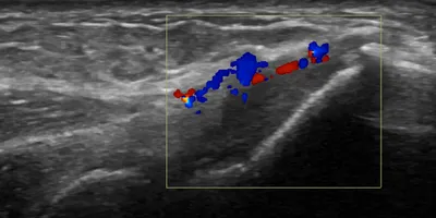 Common Extensor Tendinopathy (Tennis Elbow)