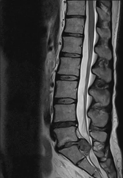 Cauda Equina compression due to lumbar disc extrusion