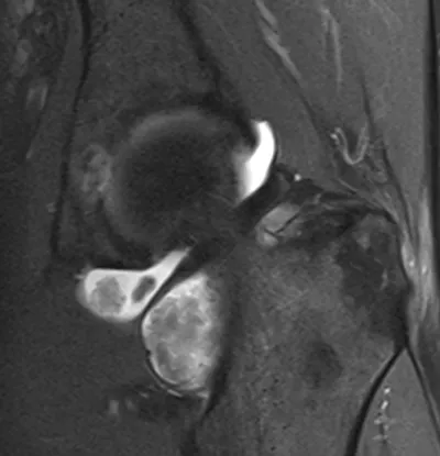 Pigmented Villonodular Synovitis