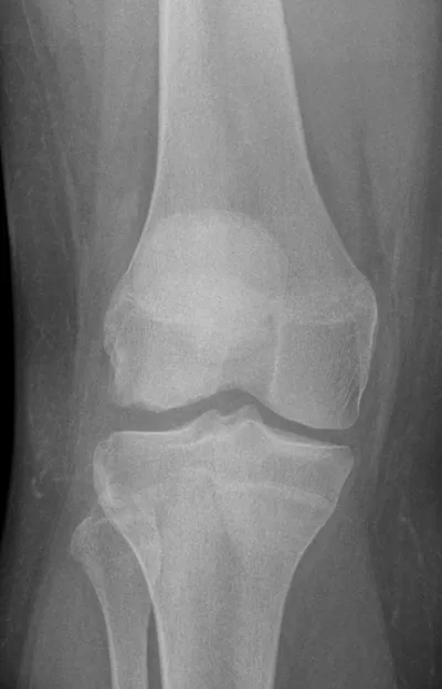Osteochdonral Injury lateral femoral condyle