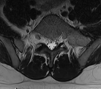 Transitional vertebra L5 - Bertolotti Syndrome