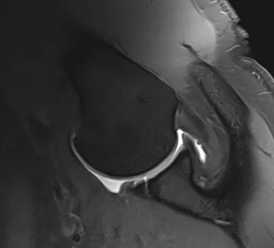 ABER view anterior glenoid labral tear