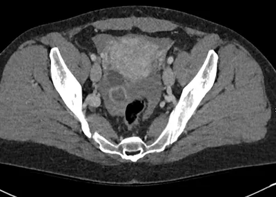 Ruptured Corpus Luteal Cyst