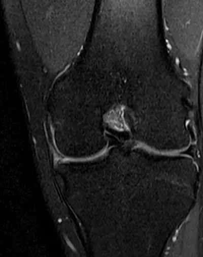 Bucket handle meniscal tear