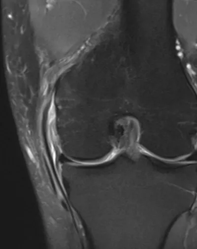 Grade 1 MCL injury