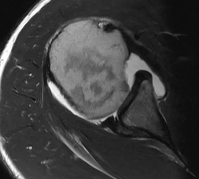 Posterior glenoid labral tear