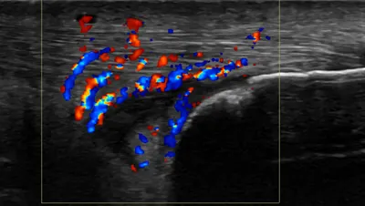Achilles tendinopathy - distal insertional