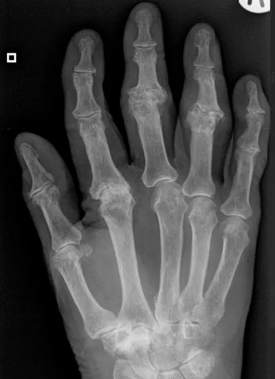 Erosive osteoarthritis (gull wing deformities)
