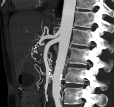 Lumbar arteries on angiography