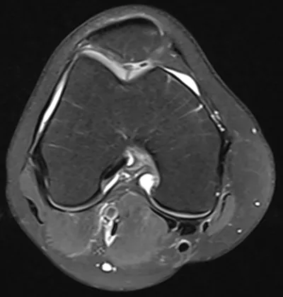 Black PD cartilage sign - chondrocalcinosis in chondral fissure