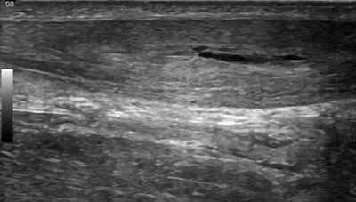 Achilles tendon interstitial tear