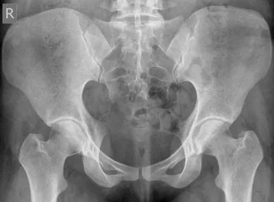 Pincer morphology femoroacetabular impingement (FAI)