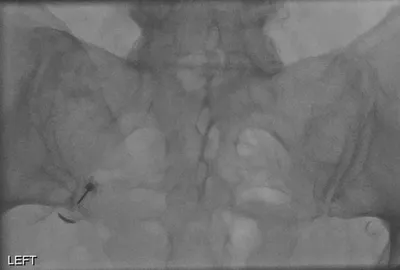 Sacroiliac Joint Injection