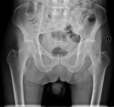 Lytic destruction Left Femoral head