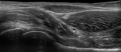 Ultrasound longitudinal appearance of adult hip