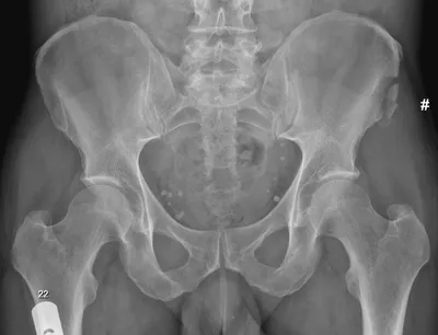 Sartorius avulsion injury