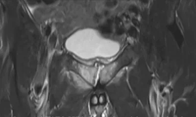 Osteitis Pubis and torn adductor magnus origins