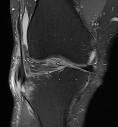 Gerdy's tubercle avulsion injury of iliotibial band